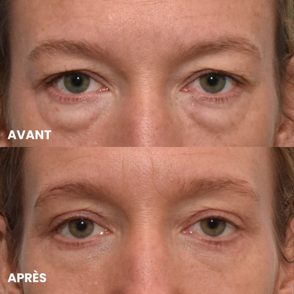 Patchs Anti-Cernes Microneedling