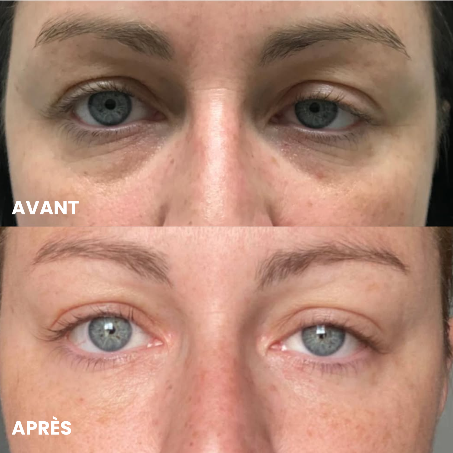 Patchs Anti-Cernes Microneedling