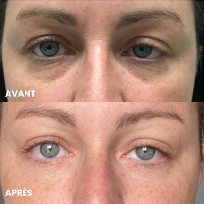 Patchs Anti-Cernes Microneedling