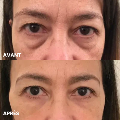 Patchs Anti-Cernes Microneedling
