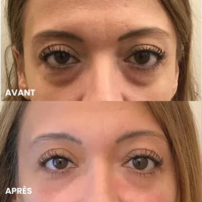 Patchs Anti-Cernes Microneedling