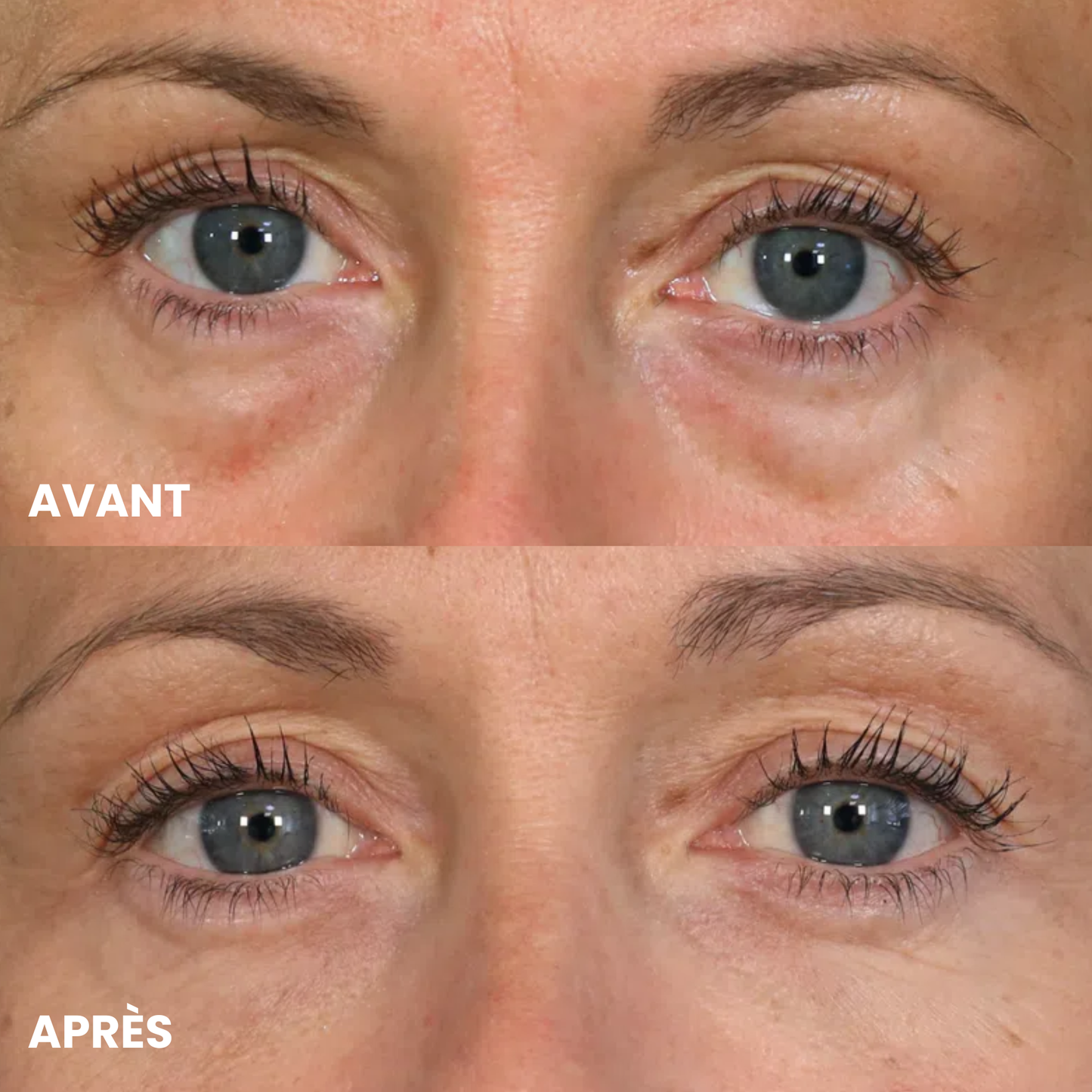 Patchs Anti-Cernes Microneedling