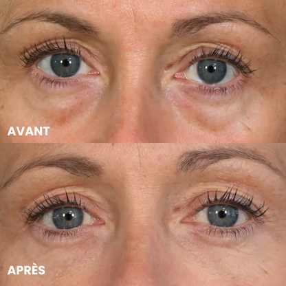 Patchs Anti-Cernes Microneedling